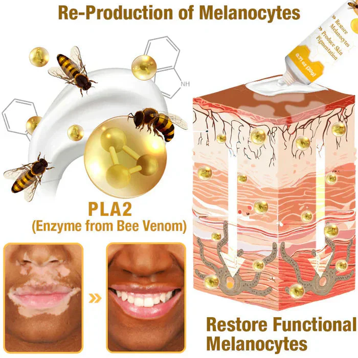 Bee Venom Vitigo Correcting Cream