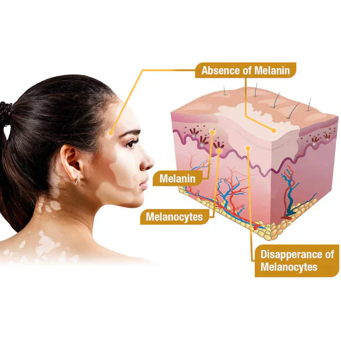 Bee Venom Vitigo Correcting Cream
