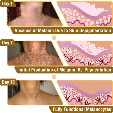 Bee Venom Vitigo Correcting Cream